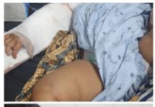 Anak Umur 1 Tahun Korban Tabrak Lari, Butuh Uluran Tangan Dermawan
